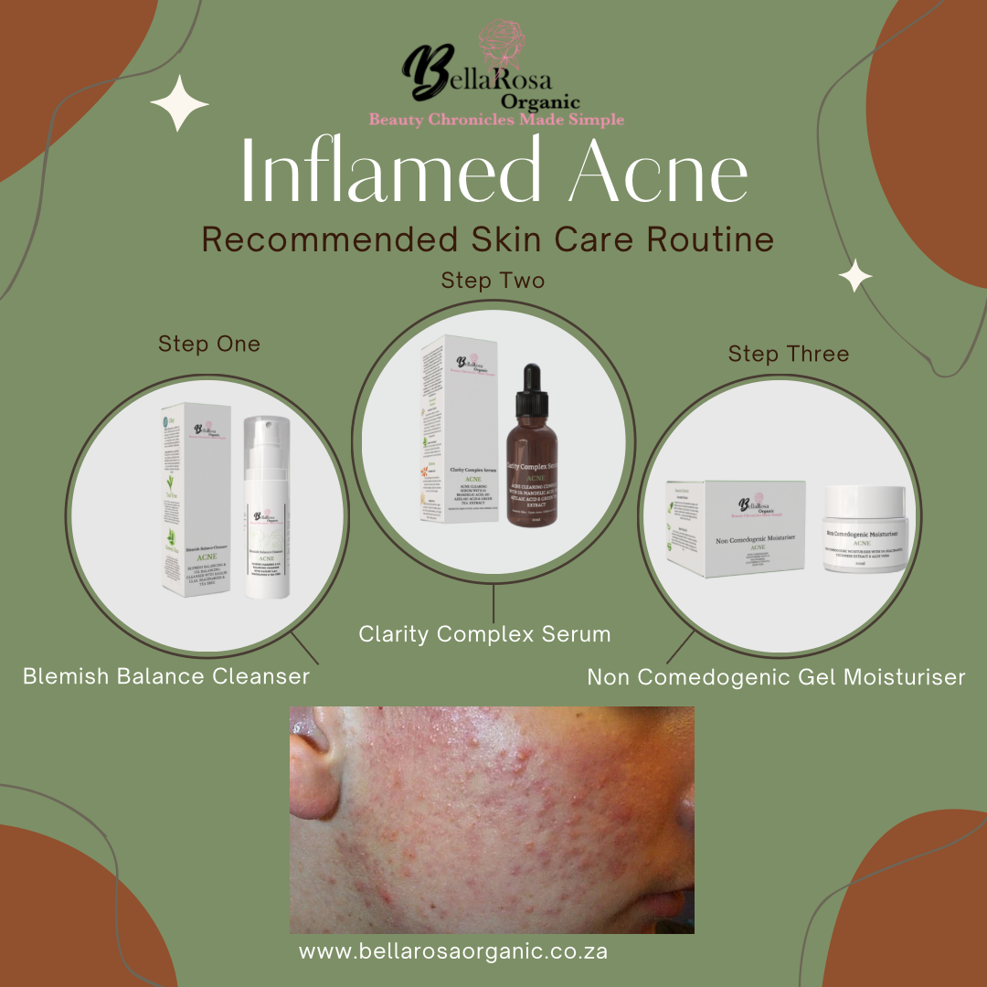 30ml Non Comedogenic Acne Moisturiser